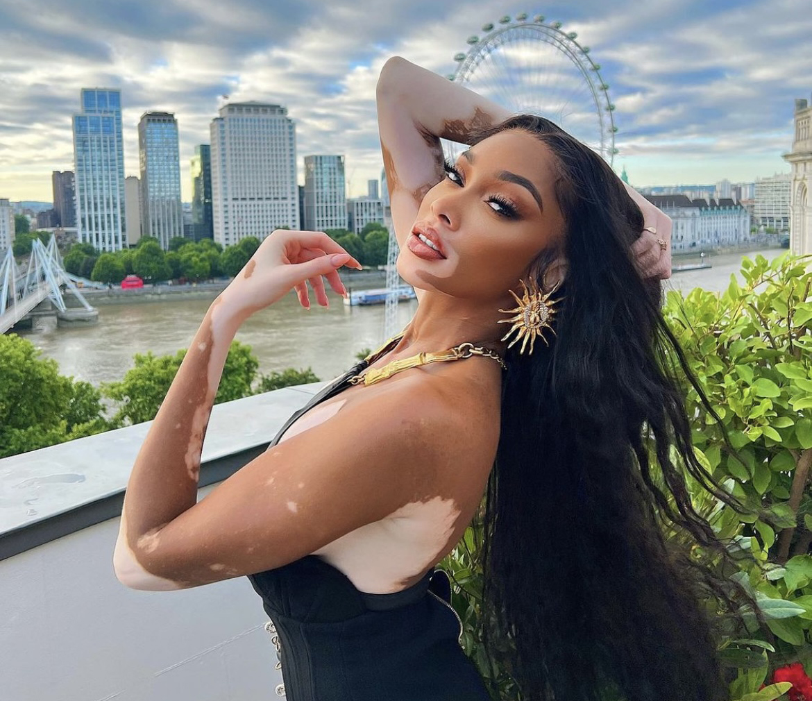 Povestea de succes a fetei bolnave de vitiligo