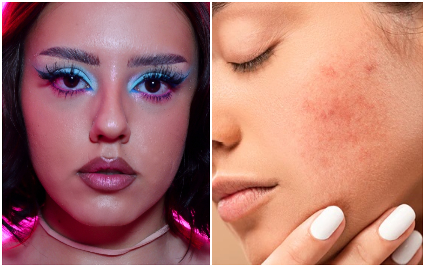 Machiajul tenului cu tendință acneică