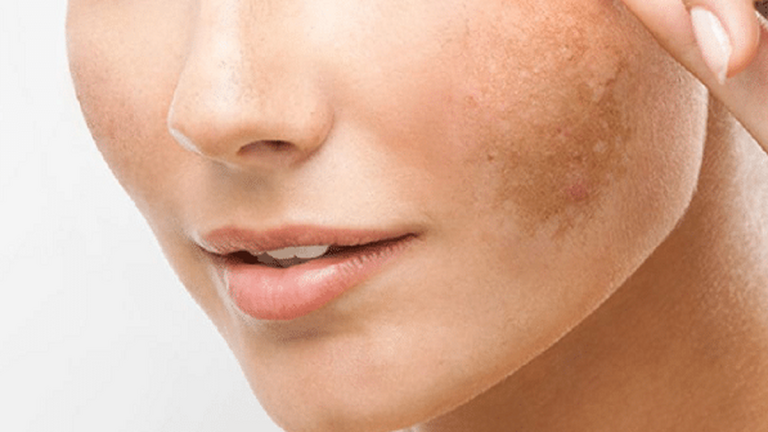 Patru ingrediente din bucătărie care te scapă de petele pigmentare. Cele mai simple și ieftine soluții pe care merită să le încerci