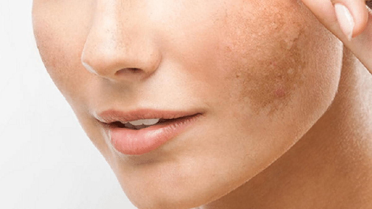 Patru ingrediente din bucătărie care te scapă de petele pigmentare