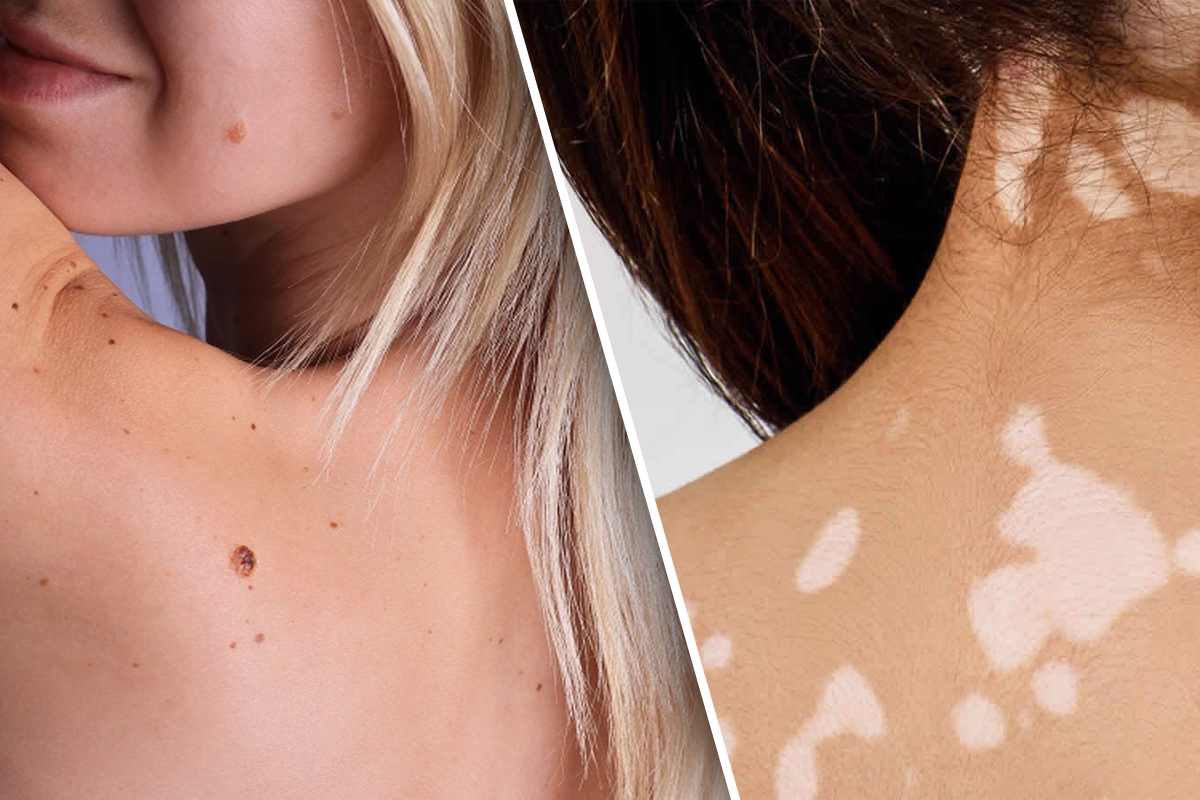 Medicul dermatolog Carmen Tudor a explicat la Ego Life