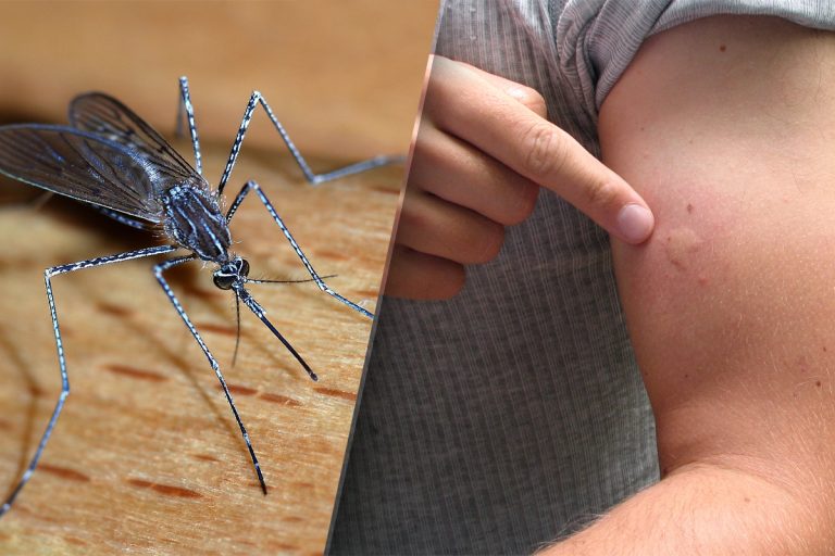 Ce să faci imediat după ce te-a înțepat un țânțar. Cel mai bun remediu care ajută pentru pielea iritată și mâncărimi