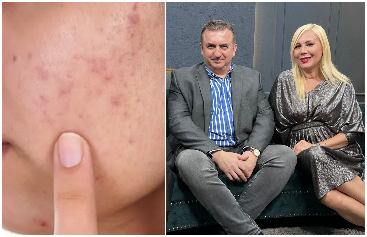 Cum scapi de cicatricele și semnele post-acneice