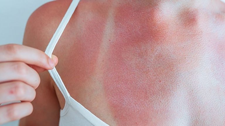 Cum te ferești de arsurile de vară și ce să faci dacă apar. Sfaturi utile pentru o vacanță fără incidente