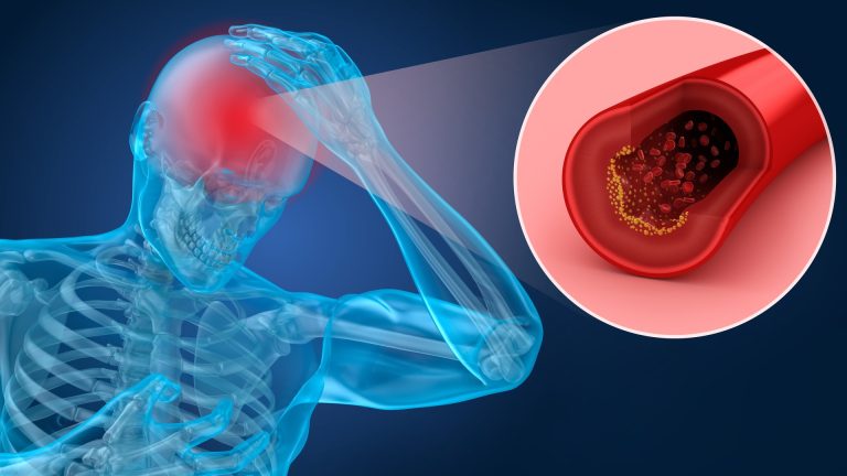 Obiceiuri aparent inofensive de seară care pot duce la AVC. Cum să te protejezi